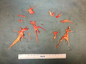 Scar tissue removed from Patrick Himmelheber's lungs. The scarring is the result of chronic thromboembolic pulmonary hypertension (CTEPH) when a mass caused by blood clots gets caught in the lungs’ blood vessels and blocks blood flow. (Photo: Courtesy Patrick Himmelheber)